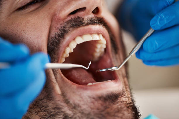 Best Emergency Tooth Extraction in Fulton, TX